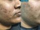 How To Get Rid Of Acne