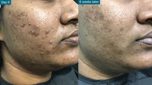 How To Get Rid Of Acne